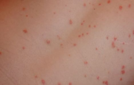Фото начальной стадии псориаза, первые симптомы заболевания и его лечение