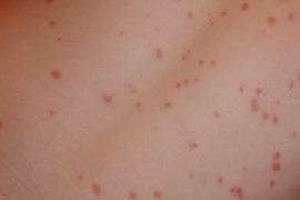 Как начинается псориаз: симптомы и признаки болезни