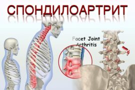 Периферический спондилоартрит что это такое