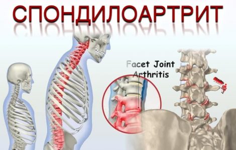 Периферический спондилоартрит что это такое