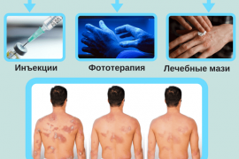 Лечение псориаза