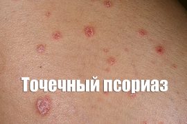 Проявление точечной формы псориаза и ее лечение