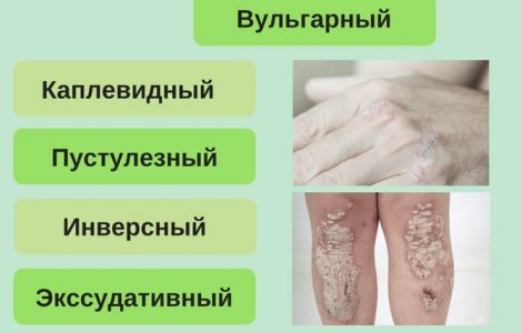 Виды псориаза и их особенности