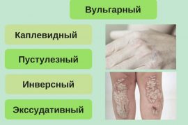 Как подтвердить диагноз псориаз