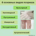 Правила жизни при псориазе. Что можно, а чего нельзя делать при псориазе.