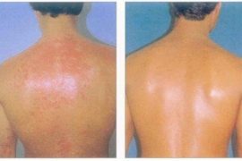 Можно ли с псориазом купаться в бассейне
