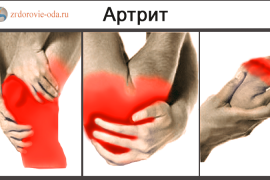 Чем отличаются артрит от артроза и что хуже для суставов