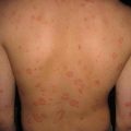 Начальная стадия псориаза: фото, симптомы и лечение