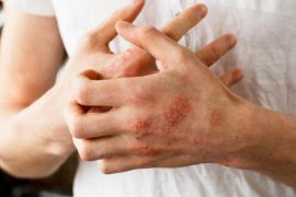 Почему больные псориазом выглядят моложе своих лет